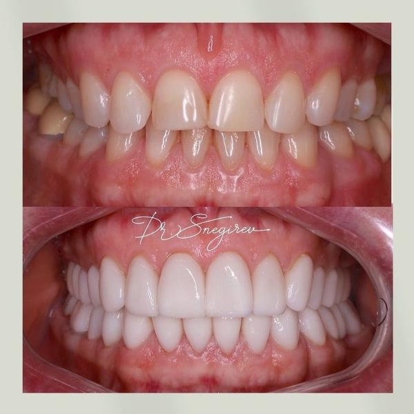 Оптимизация прикуса и полная реставрация зубных рядов керамическими реставрациями